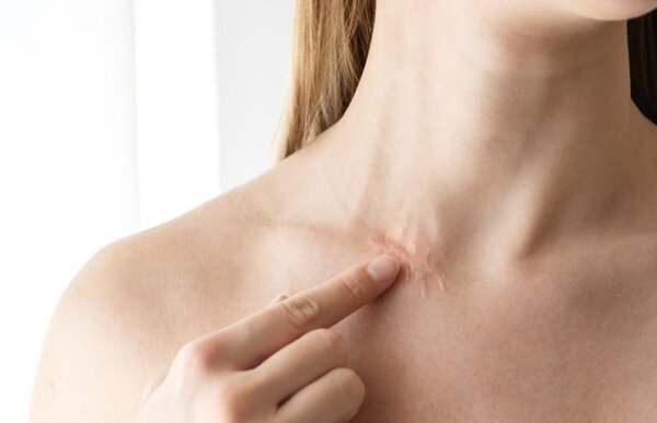 Thời gian ăn kiêng chống sẹo thâm bao lâu?