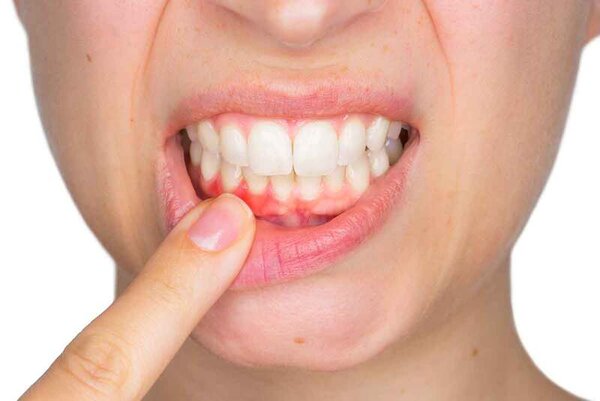 Một số biểu hiện của tụt lợi