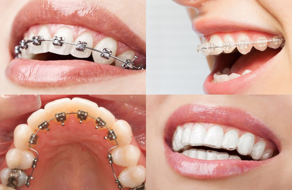 Top 10 nha khoa niềng răng uy tín nhất tại TPHCM mà bạn có thể tham khảo Top 10 nha khoa niềng răng uy tín nhất tại TPHCM mà bạn có thể tham khảo